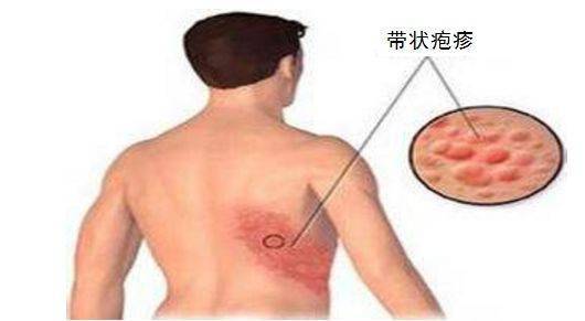 最新疱疹病毒治疗药物解析