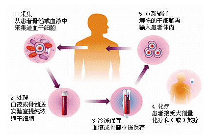 干细胞技术助力脊髓损伤康复，喜讯频传！