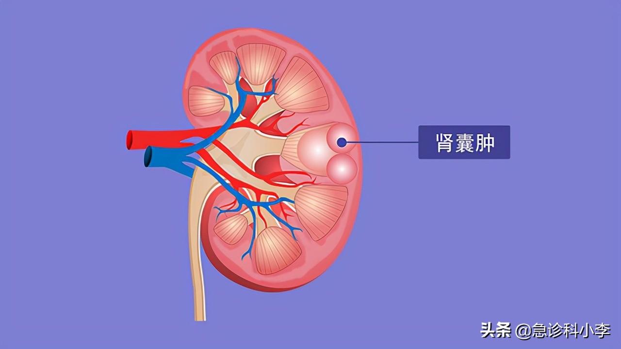 “最新多发性脂囊瘤治疗技术解析”