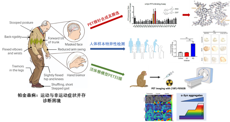 帕金森病研究新动态